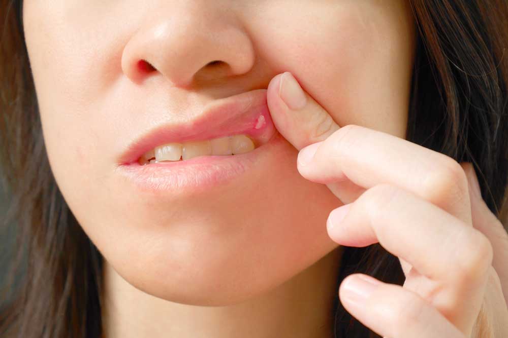 Common Reasons for Sores in the Mouth