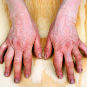 Do you have psoriatic arthritis symptoms