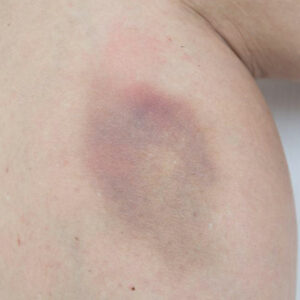 Easy bruising &#8211; Causes and treatments