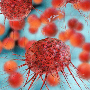 Everything you need to know about metastatic ovarian cancer