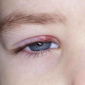 Know about the Symptoms and Causes of Eyelid Inflammation