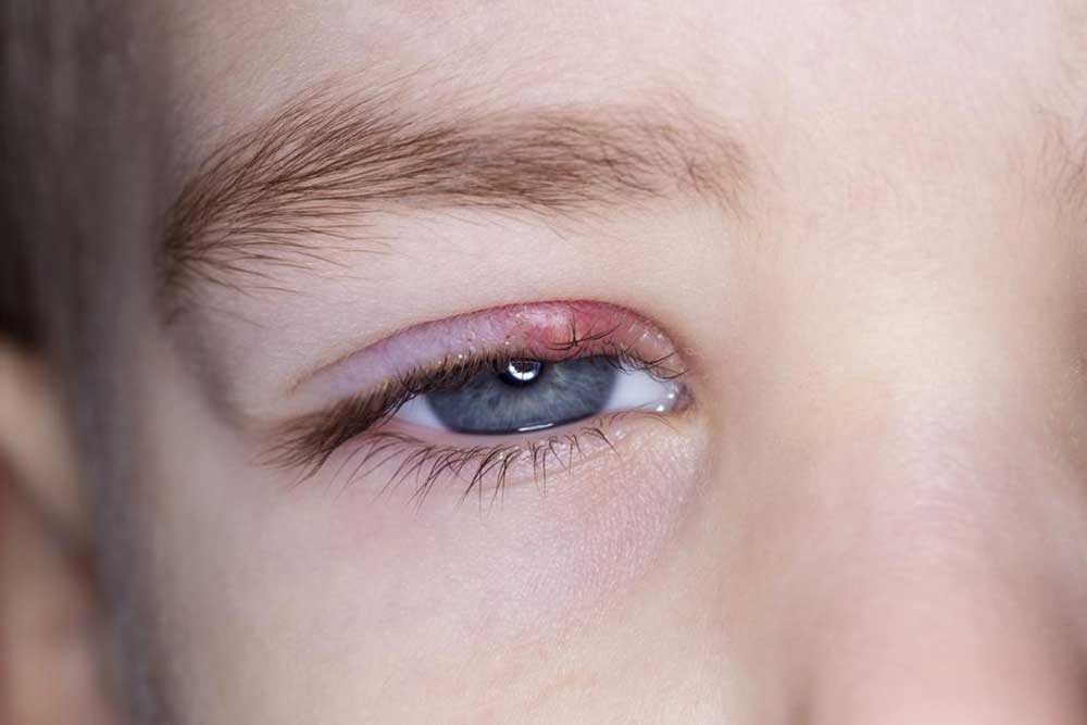 Know about the Symptoms and Causes of Eyelid Inflammation