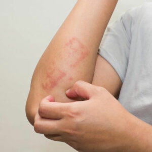 How to identify and treat poison ivy rash with daily use products