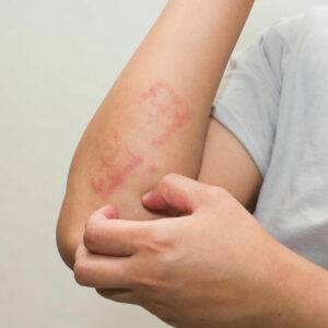 Here&#8217;s all that you need to know about scabies skin rash