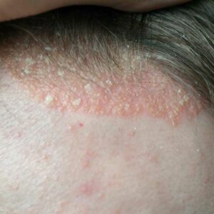 Scalp Psoriasis &#8211; Symptoms to Watch out For