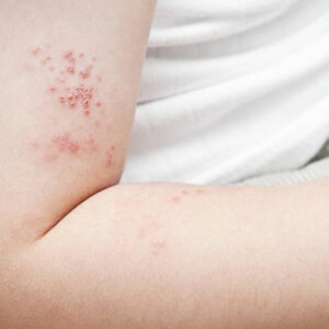 Prevent yourself from shingles before it infects you