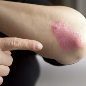 Psoriasis Symptoms