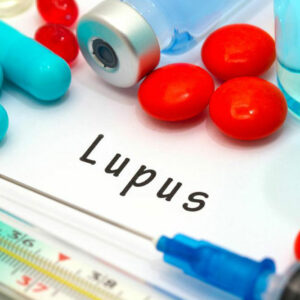 Remedies for Lupus