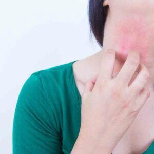 10 over-the-counter treatments for eczema that offer better results