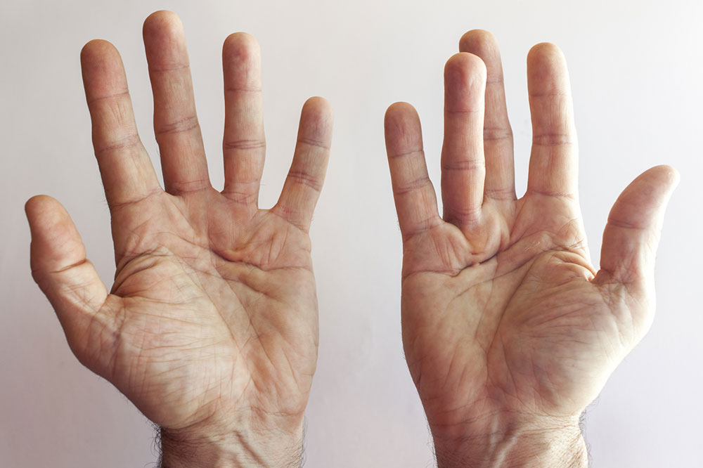 4 hand exercises for Dupuytren&#8217;s contracture patients