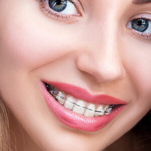 5 things you should know before you get braces