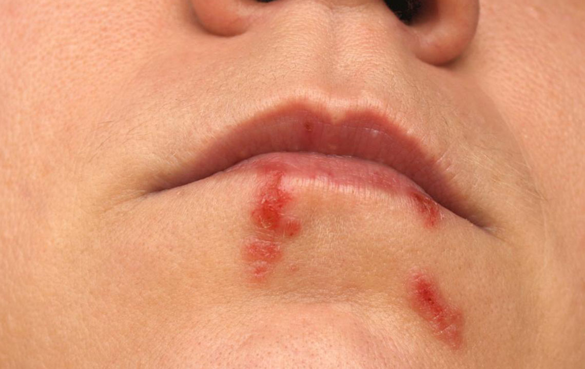 6 Effective Remedies for Treating Cold Sores