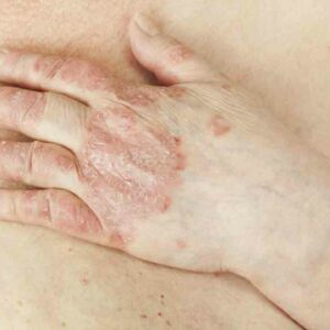 All the Information on Psoriasis You Need to Know