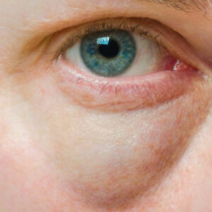 Bags Under the Eyes &#8211; Symptoms, Causes, and Treatment