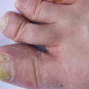 Guide to Treating Toenail Fungus