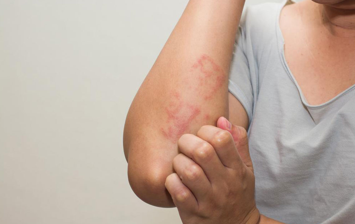 Eczema &#8211; Types, Causes, Symptoms, and Treatment