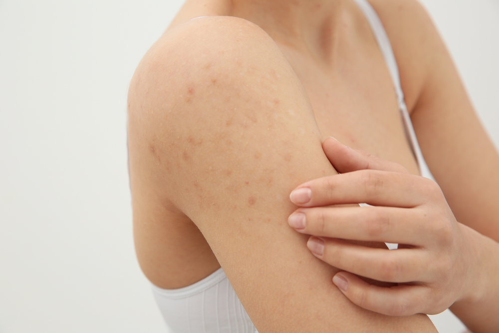 Everything You Need To Know About Hiv Skin Rash