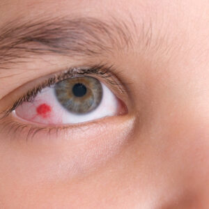 Eye infections &#8211; All you need to know