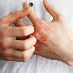 Foods to Eat and Avoid for Patients with Eczema