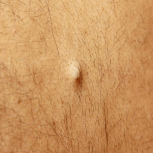 Facts and Signs of Ingrown Hair