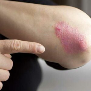 Home Remedies to Manage the Symptoms of Plaque Psoriasis