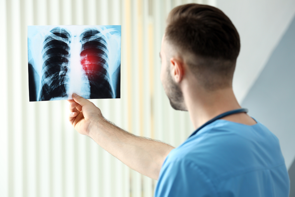 Lung Cancer &#8211; Risk Factors, Diagnosis, Symptoms, And Treatment