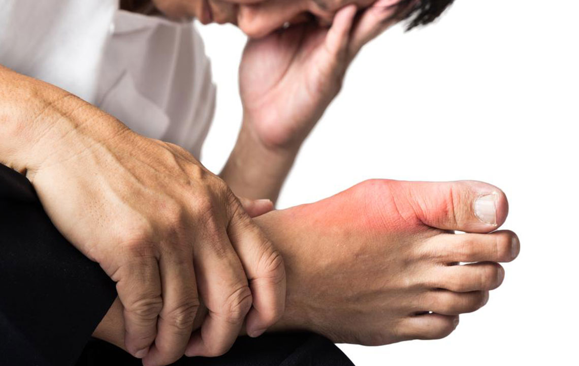 Symptoms and Treatments for Gout