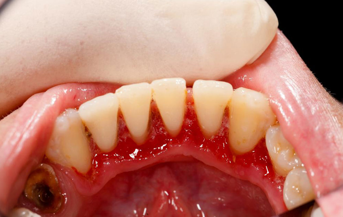 Top 8 natural treatments for gum disease