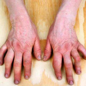 Understanding the Symptoms of Rheumatoid Arthritis