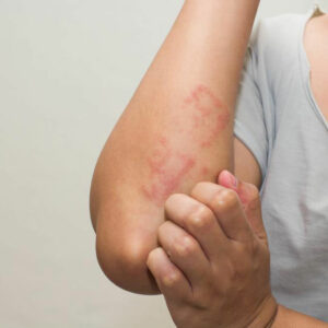 Various Effective Treatment Options For Atopic Dermatitis