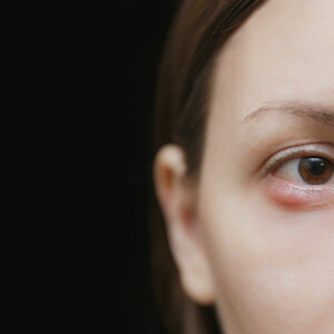 3 Ways to Get Rid of a Chalazion