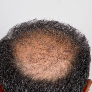 Hair Transplant &#8211; Types, Procedure, and Cost